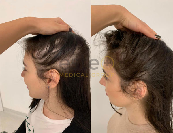 Before and after laser hair regrowth 