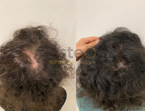 Treatments for female hair loss 