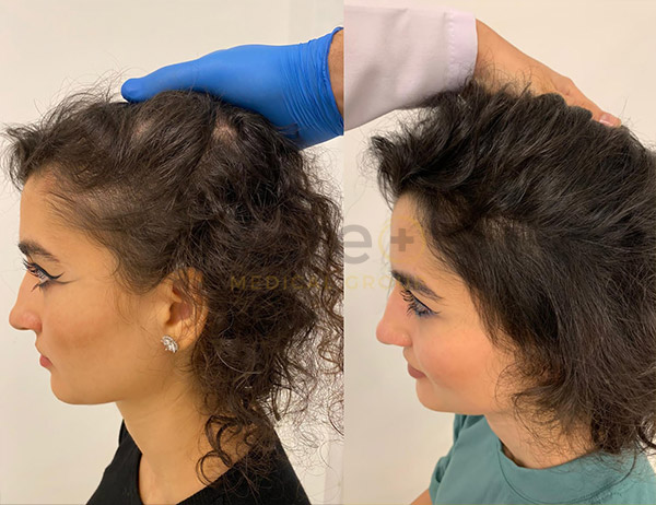 Treatments for female hair loss 