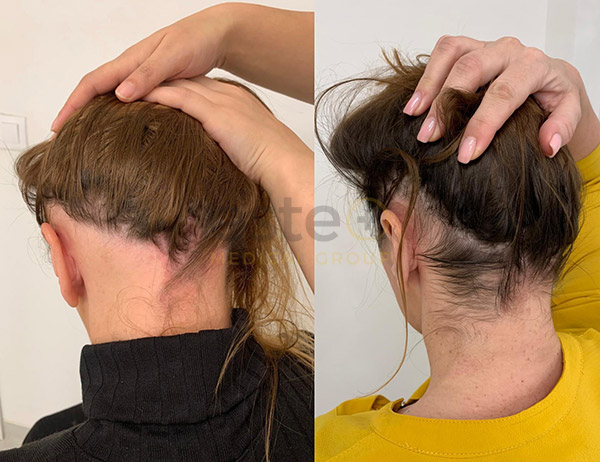 Treatments for female hair loss 