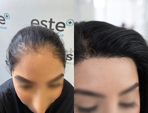 Treatments for female hair loss 