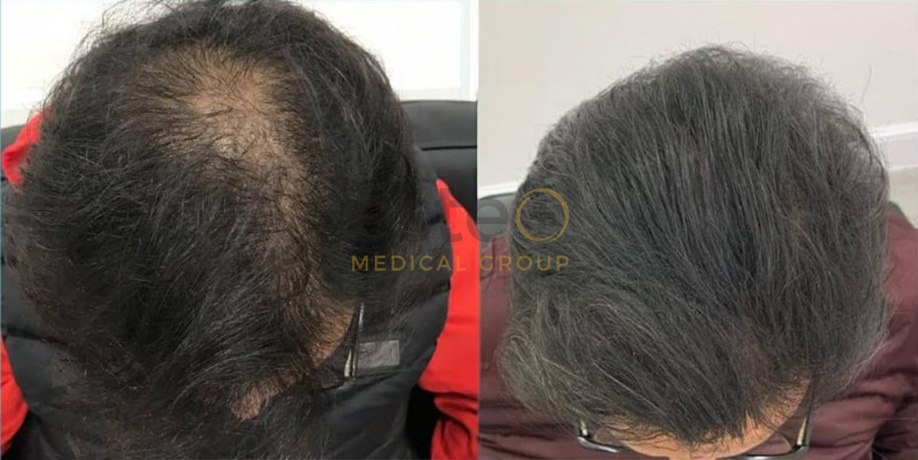 Laser Hair Regrowth Before & After