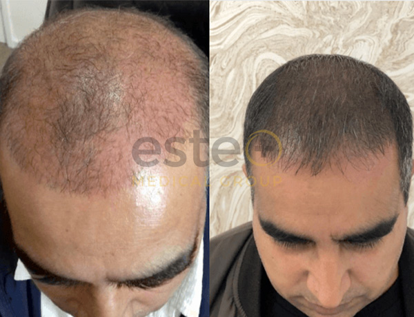 Laser Hair Regrowth Before & After