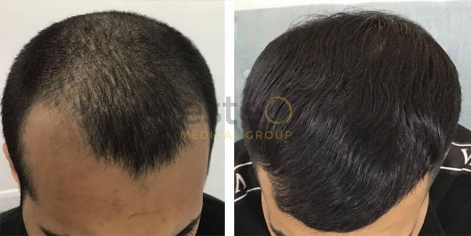 Laser Hair Regrowth Before & After