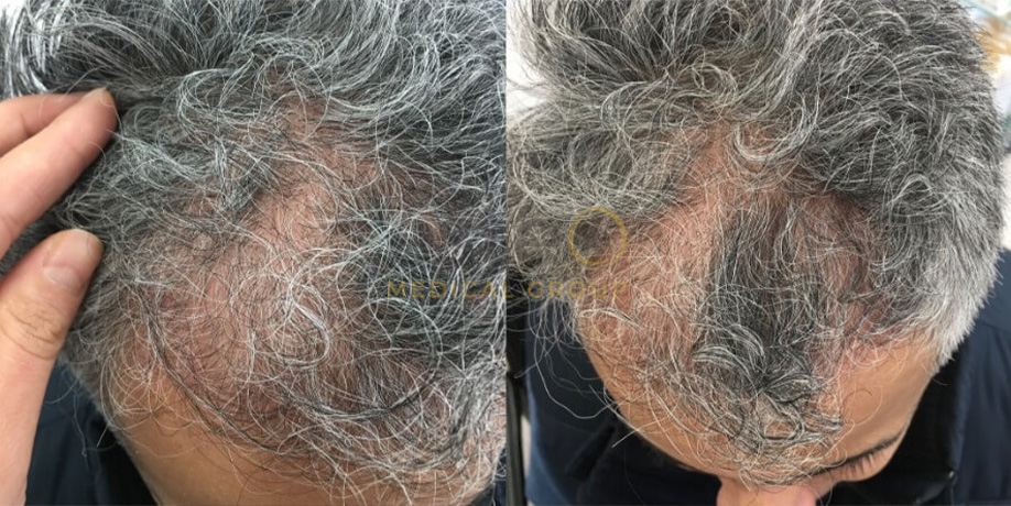 Laser Hair Regrowth Before & After