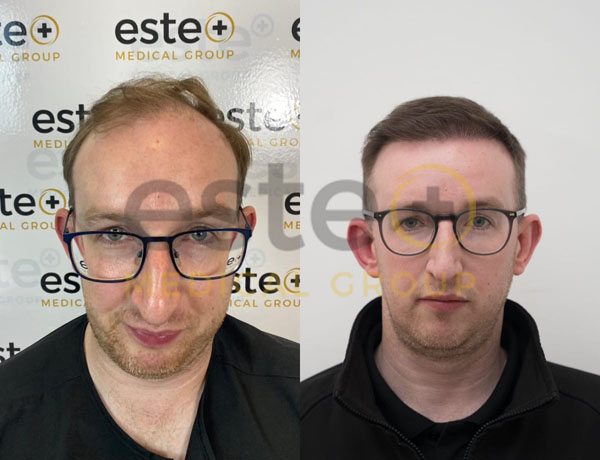 FUE Hair Transplant Results