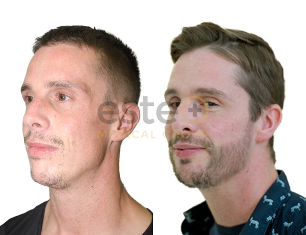 Carl _ Hair transplant before after image