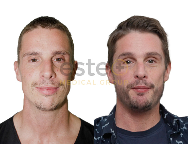 Carl _ Hair transplant before after image