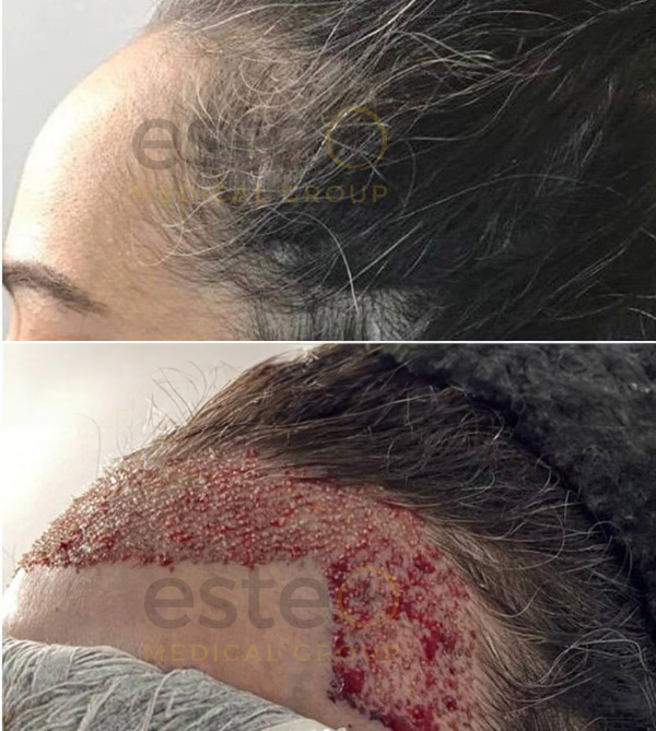 FUE Hair Transplant