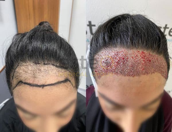 FUE hair transplant results