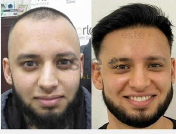 Hair transplant before and after Leeds