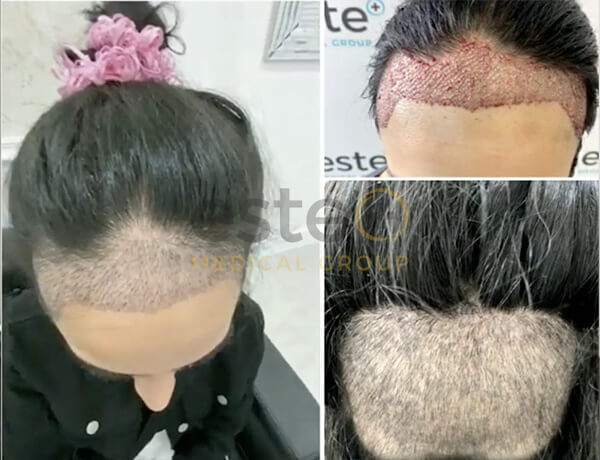 Hair transplant before and after Leeds
