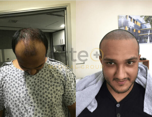 Hair transplant before and after Leeds