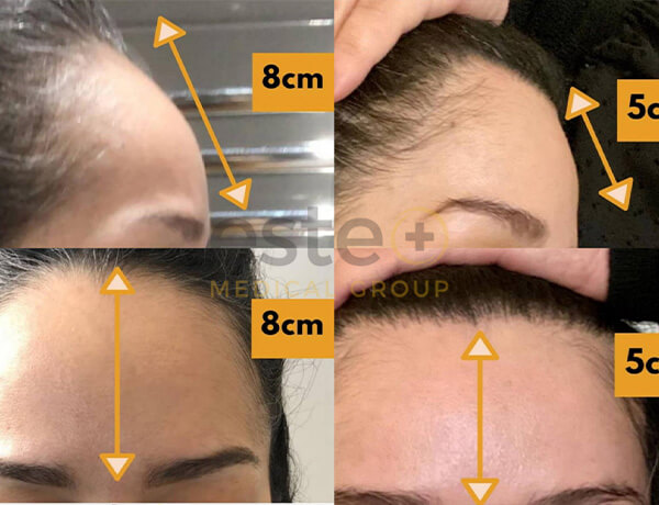 Hair transplant before and after Leeds