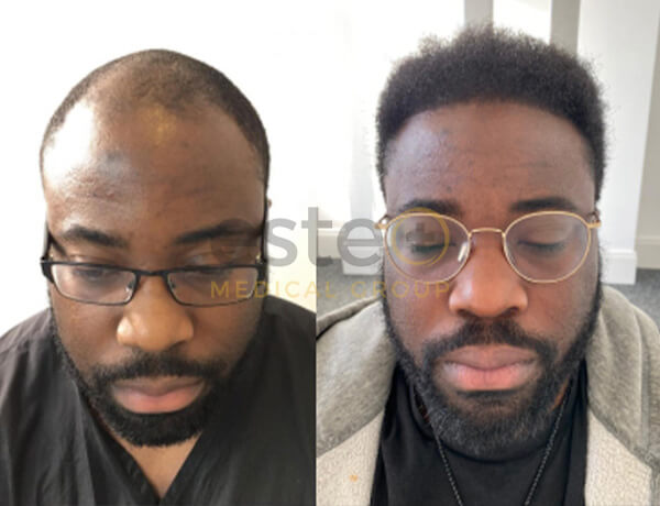 Hair transplant before and after Leeds
