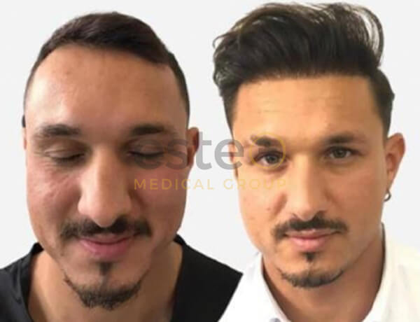 Hair transplant before and after Leeds