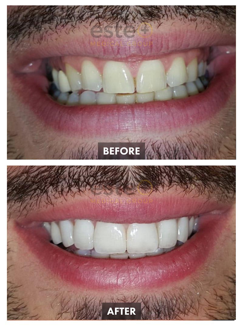 Veneers Before and After
