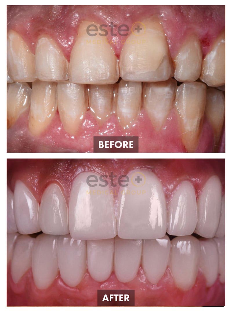 Veneers Before and After