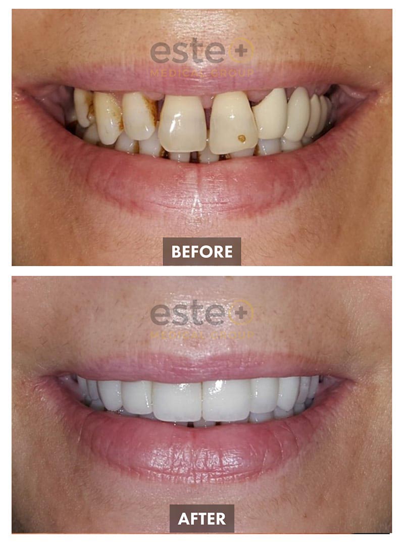 Veneers Before and After
