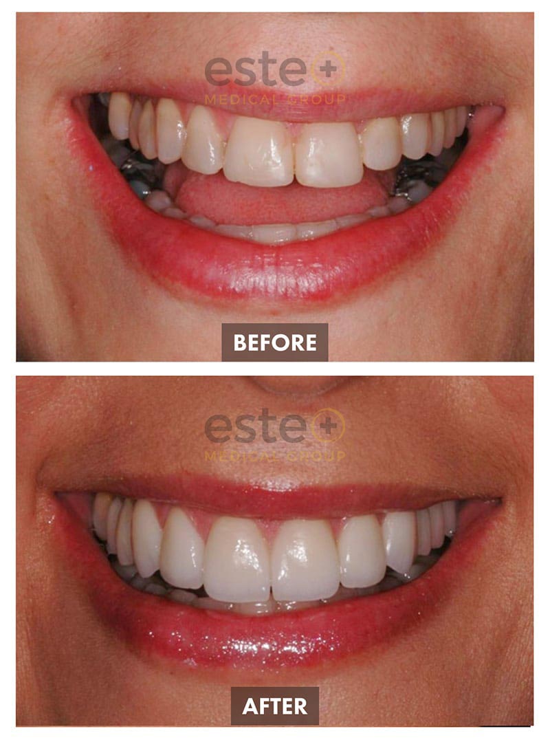 Veneers Before and After