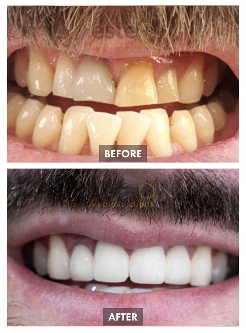 Veneers Before and After