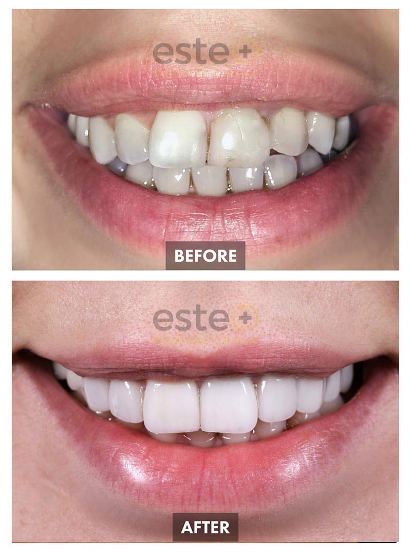 Veneers Before and After