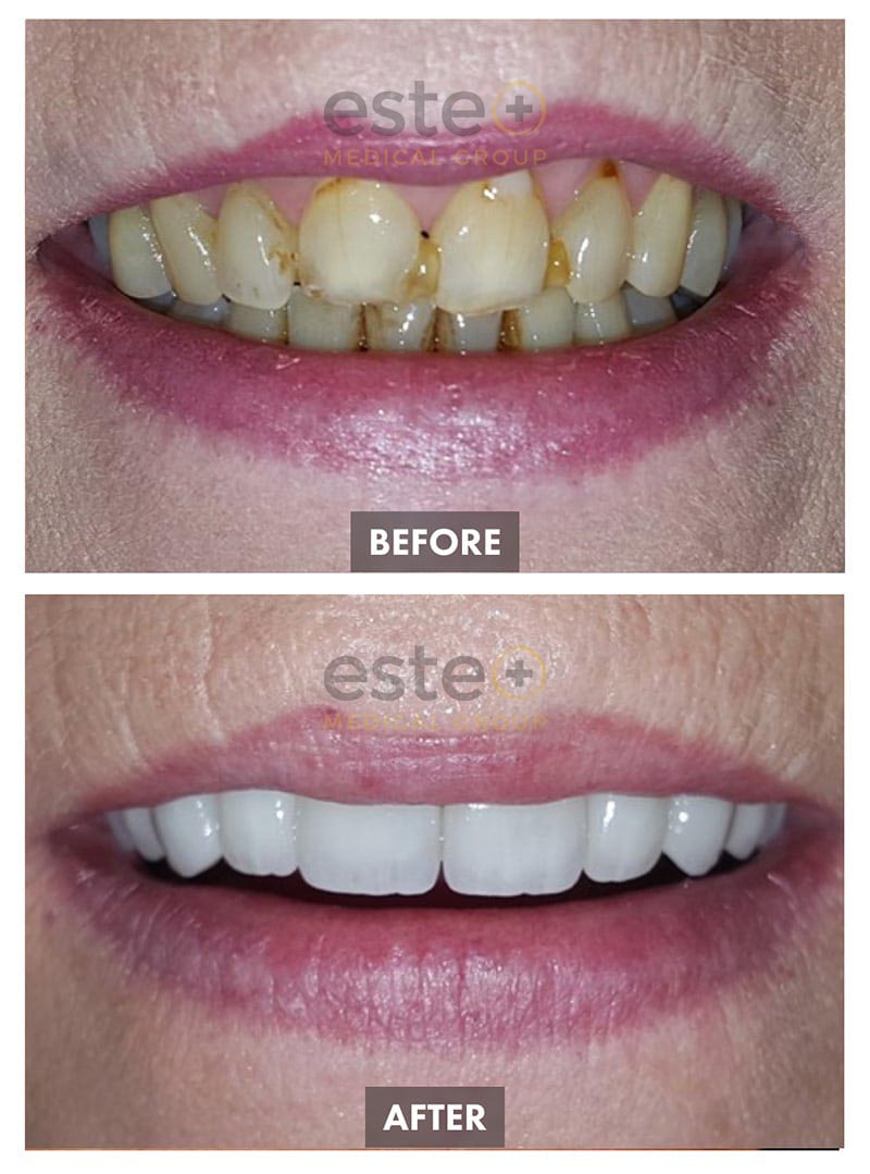 Veneers Before and After