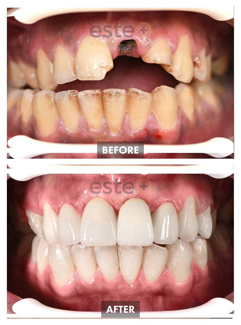 Implants Before and After