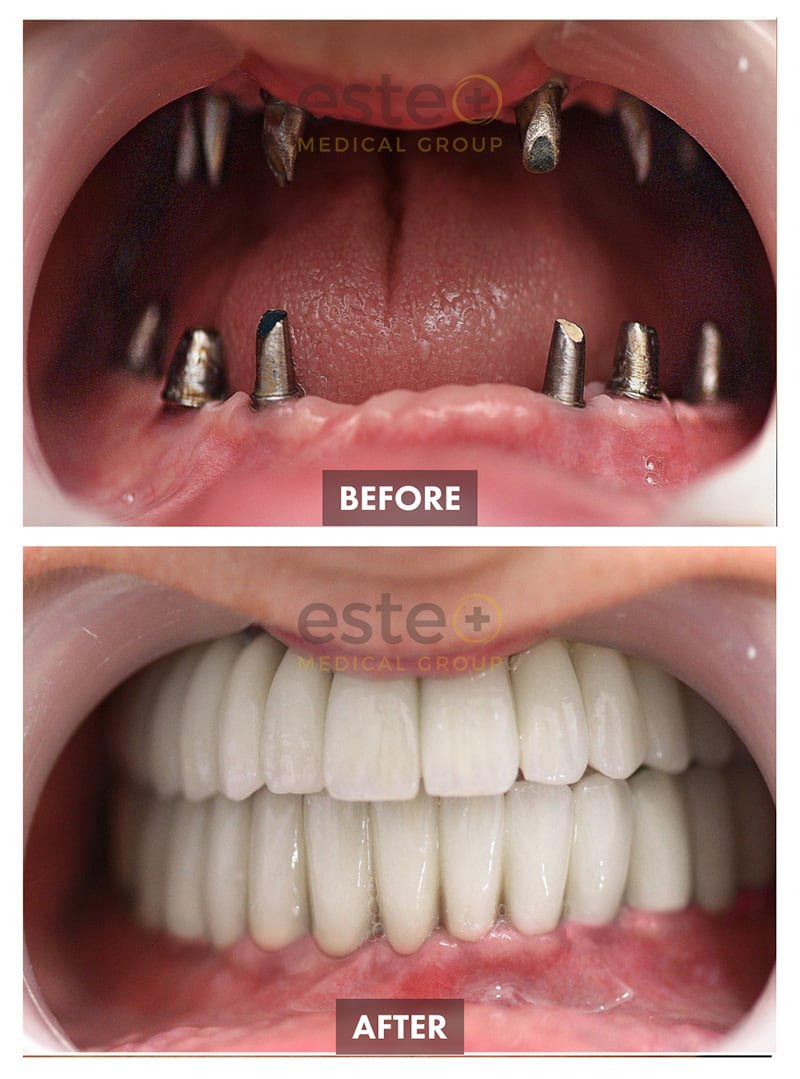 Implants Before and After