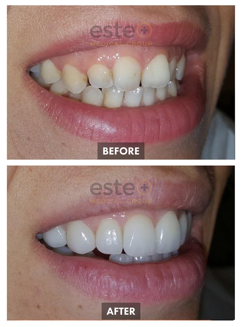 Veneers Before and After