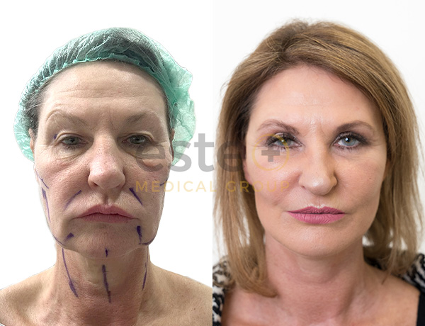 What makes FUE Hair Transplant Procedure the most Successful Technique?