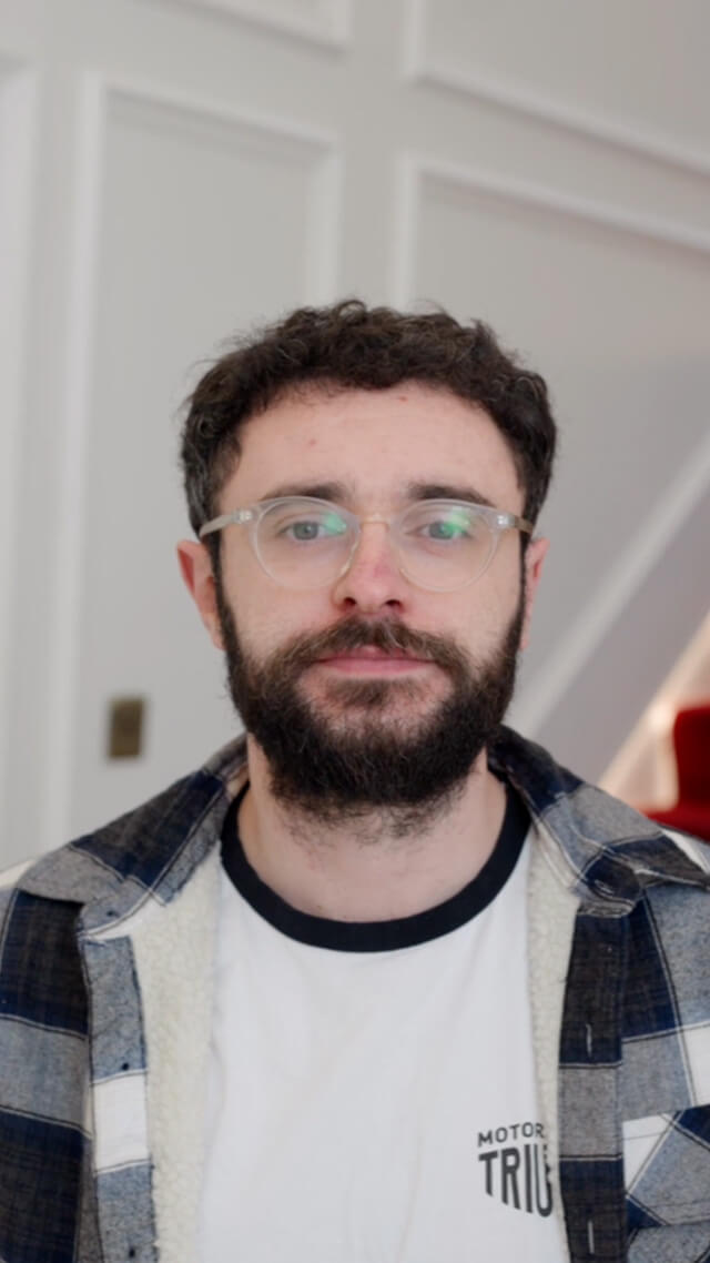 Connor Hair transplant before after post 8 months