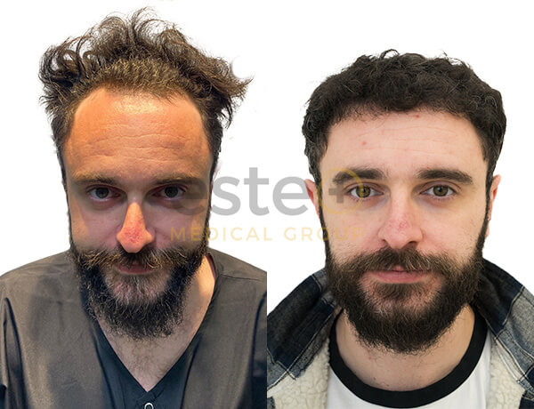 Connor Hair transplant before after post 8 months