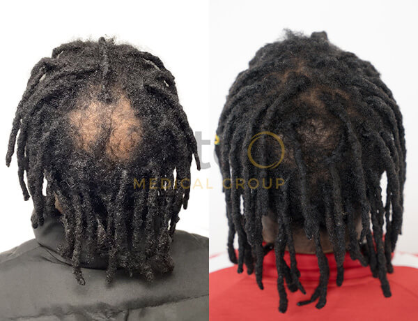 Hair transplant before and after Leeds