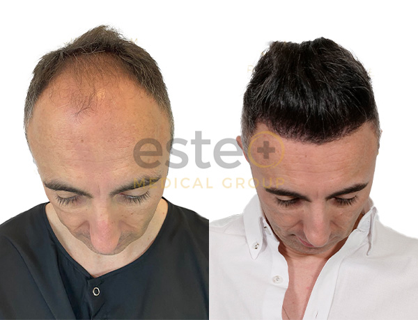 Hüseyin Özbaş - Lazer hair regrowth post hair transplant - Este Medical