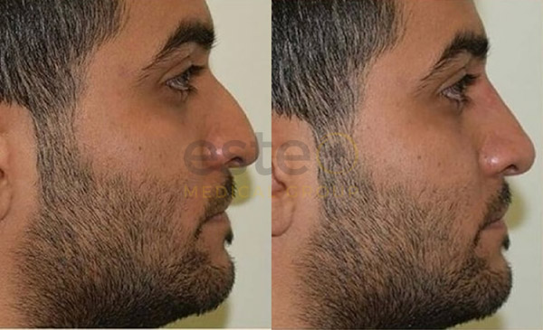 Non-Surgical Rhinoplasty before after results