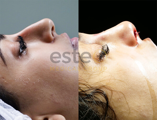 Nose Job Before and After Results