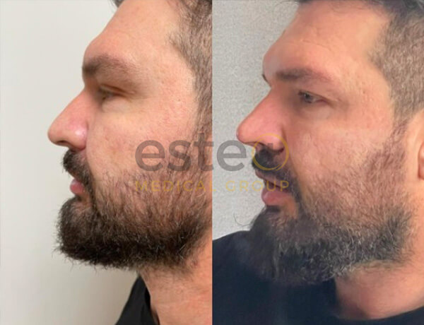 Nose Job Before and After Results