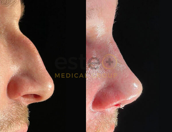 Nose Surgery