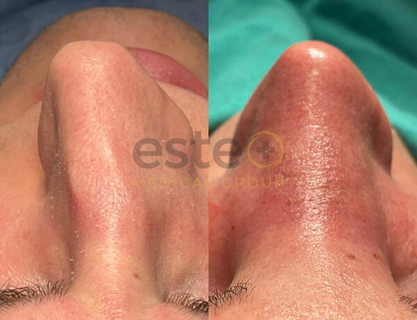 Nose Surgery