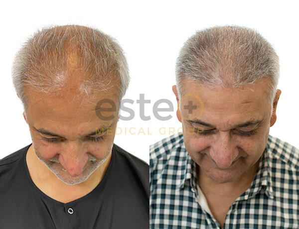 Kuldip hair transplant before after images - Este