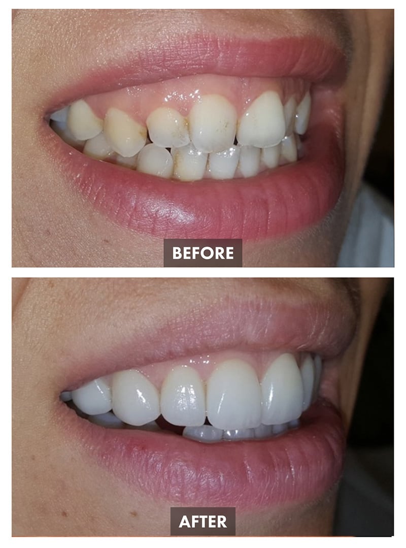 Dentistry Before-after Images - Este