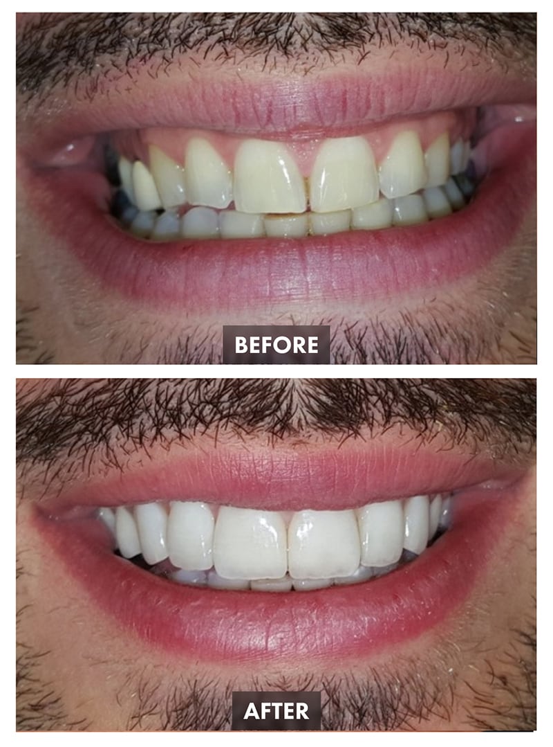Dentistry Before-after Images - Este