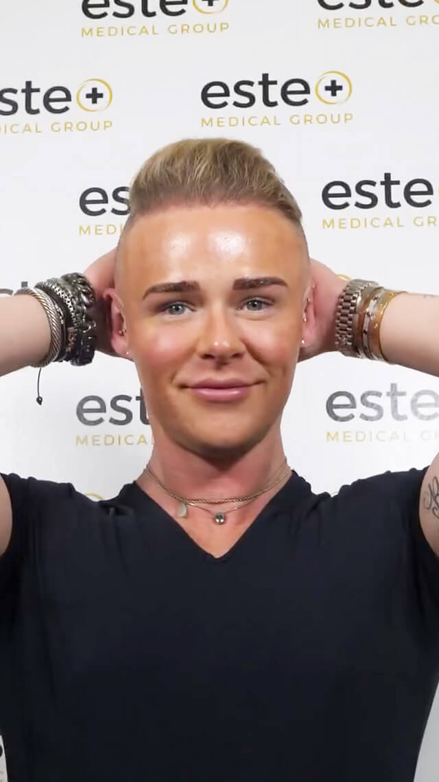 Sean Hair Transplant - Este UK