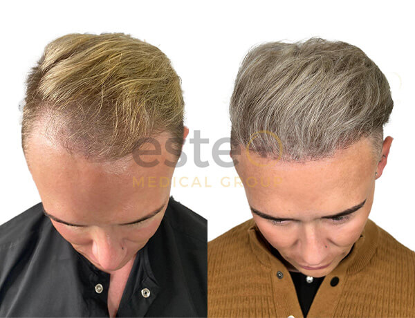 Hair transplant before and after Leeds