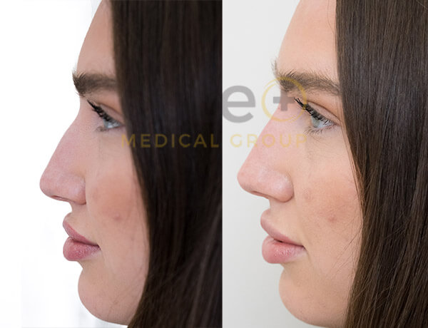 Jo _ Nose Fillers - Este