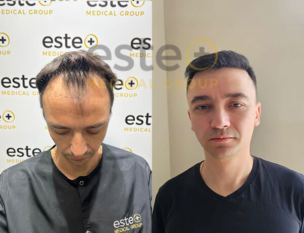 MIkhail Hair transplant before after images - Este