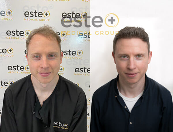 Anthony Potts - 8 months post Hair Transplant - Este Medical