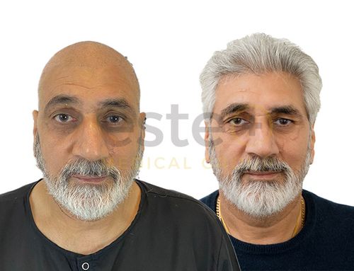 hair transplant result