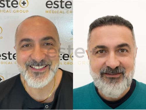 Hair transplant before and after